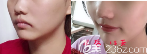 日照醫(yī)療美容醫(yī)院隆鼻案例一