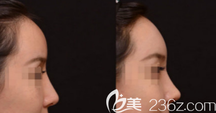 日照醫(yī)療美容醫(yī)院隆鼻案例二