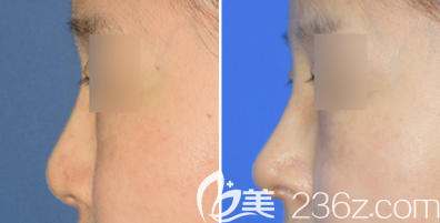 日照醫(yī)療美容醫(yī)院隆鼻案例三