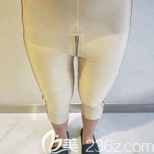 天伊美整形醫(yī)生張柏松為我做大腿吸脂術(shù)后腿部腫脹