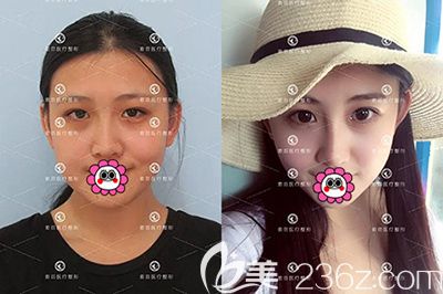 哈爾濱索菲陳富全隆鼻效果對比