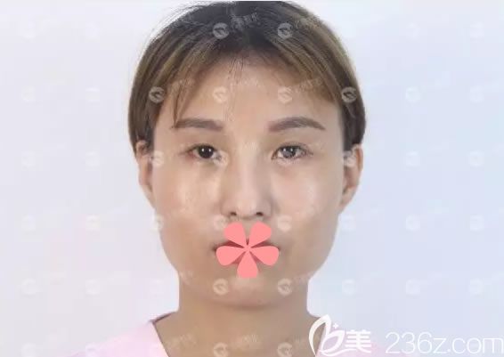 在福州名韓整形做雙眼皮術(shù)前照 在福州名韓整形做雙眼皮術(shù)前照