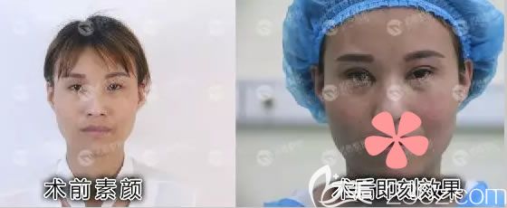 王女士術(shù)前素顏和術(shù)后即刻效果圖 王女士術(shù)前素顏和術(shù)后即刻效果圖