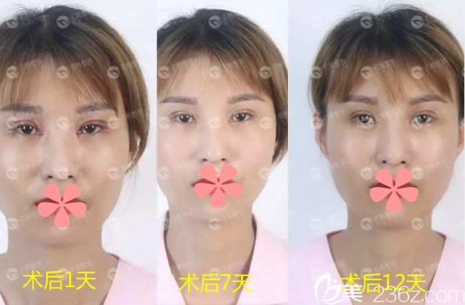 7mm全切雙眼皮恢復(fù)過程圖 7mm全切雙眼皮恢復(fù)過程圖