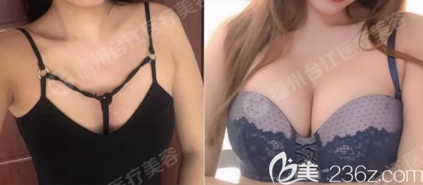 妹子講述去福州臺江整形做曼托圓形毛面水滴型假體隆胸的恢復(fù)實況 以個人經(jīng)驗分享曼托毛面和光面哪個手感好?