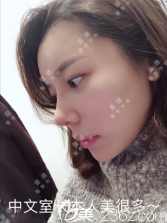 正面鼻子大鼻修復(fù)面診韓國Mind曼德整形適合基礎(chǔ)差的價(jià)格5.7萬左右