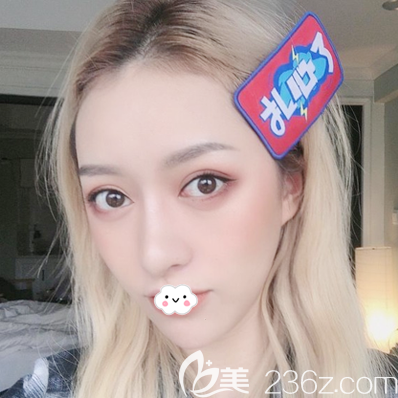 深圳yestar藝星整形醫(yī)院雙眼皮隆鼻做的怎么樣