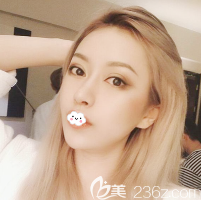 深圳yestar?？溯x醫(yī)生雙眼皮隆鼻案例15天效果圖