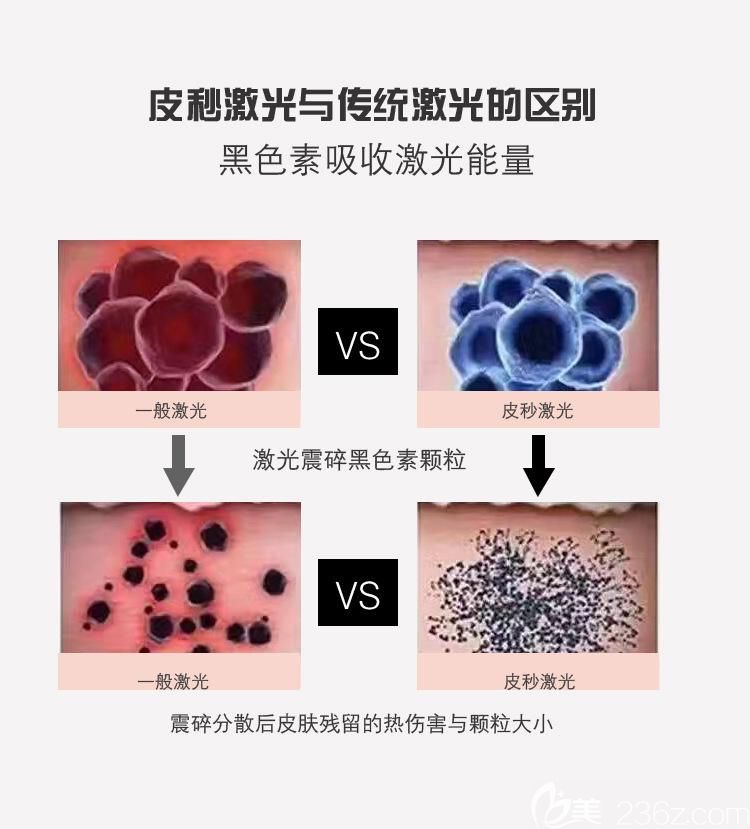 針對(duì)遺傳性雀斑更建議皮秒去除，OPT只能淡化