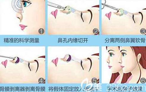 假體隆鼻示意圖