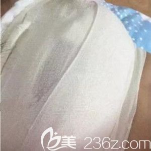 假體隆胸術(shù)后1天照