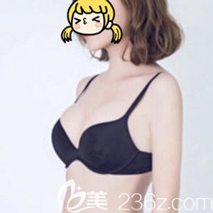 做進(jìn)口曼托假體豐胸術(shù)后20天效果圖