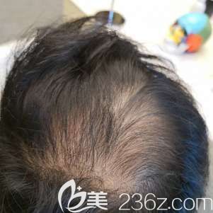 到武漢藝星做發(fā)際線種植前自己稀疏的頭發(fā) 到武漢藝星做發(fā)際線種植前自己稀疏的頭發(fā)