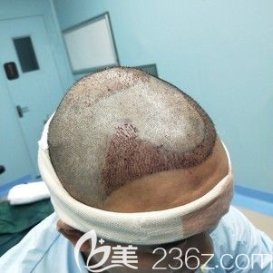 <!--<i data=20240703-sp></i>-->主任幫我做發(fā)際線種植術(shù)后即刻 <!--<i data=20240703-sp></i>-->主任幫我做發(fā)際線種植術(shù)后即刻