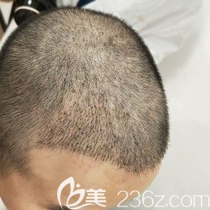 做發(fā)際線種植術(shù)后15天腫脹消失 做發(fā)際線種植術(shù)后15天腫脹消失