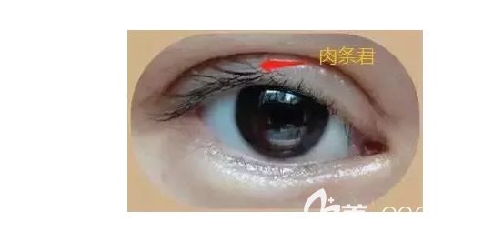 割雙眼皮后有肉條圖片
