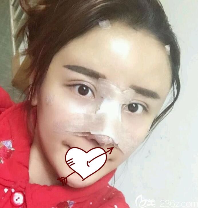 找合肥壹美尚整形<!--<i data=20240703-sp></i>-->做假體隆鼻失敗修復手術(shù)第1天