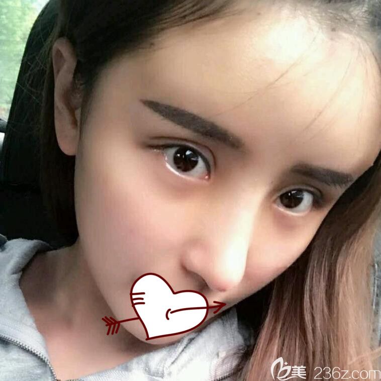 <!--<i data=20240703-sp></i>-->做隆鼻失敗修復術(shù)后第5天