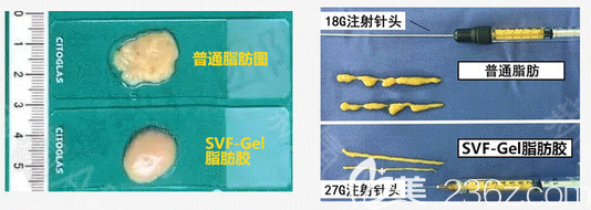 SVF-Gel脂肪膠和普通脂肪對比圖