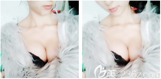 假體隆胸術(shù)后一個(gè)月恢復(fù)照片