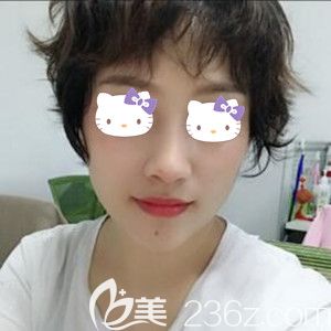 做完鼻綜合后對顏值提升有多大？看我找海南華美郭文煜做肋軟骨鼻綜合+假體墊下巴術(shù)后30天恢復效果圖就知道了！