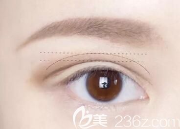 割雙眼皮術(shù)后出現(xiàn)疤痕增生怎么辦？怎樣防止疤痕增生呢？