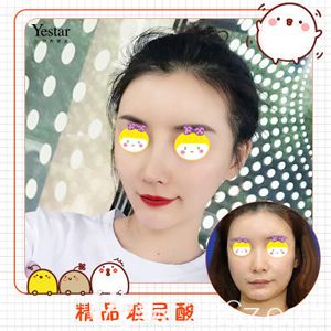 武漢藝星注射玻尿酸術(shù)前術(shù)后對比效果