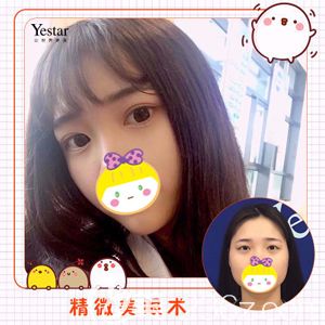 主任做切開雙眼皮術(shù)后眼睛線條自然流暢