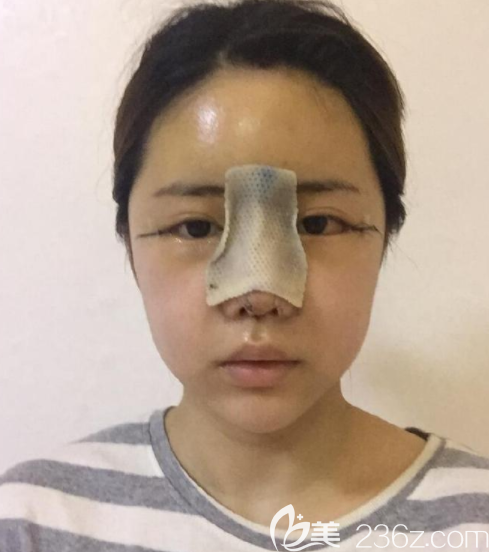 韓國朱諾整形金信榮隆鼻真人案例 韓國朱諾整形金信榮隆鼻真人案例