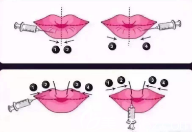打嘟嘟唇的手術(shù)示意圖