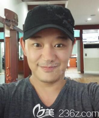 韓國(guó)JK整形臉部提拉、額頭提升、雙眼皮、鼻綜合3個(gè)月后讓人直呼不敢相信