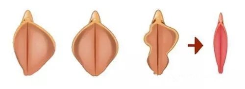 私密整形中陰蒂整形手術(shù)步驟簡易圖