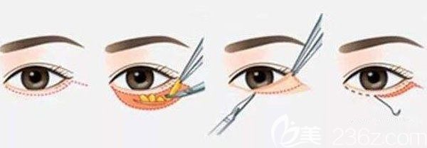 內(nèi)切去眼袋