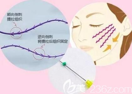 埋線提升效果好不好？埋線提升是不是用線越多越好?