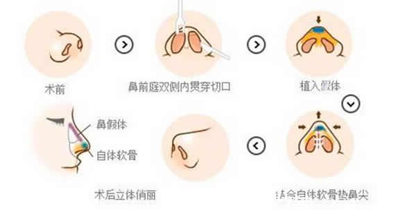 耳軟骨墊鼻尖原理圖解