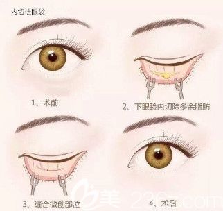 內(nèi)切祛眼袋手術(shù)流程
