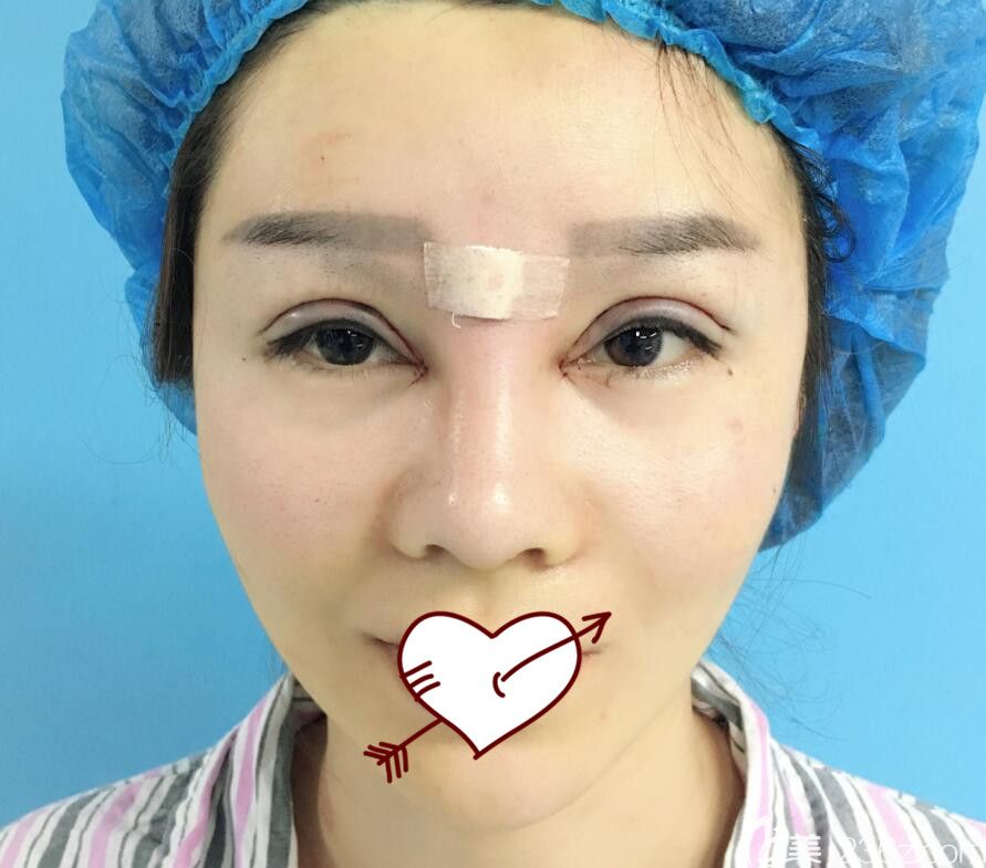 找合肥臺(tái)美麗格整形葉凡做眼綜合+鼻部修復(fù)術(shù)后即刻照