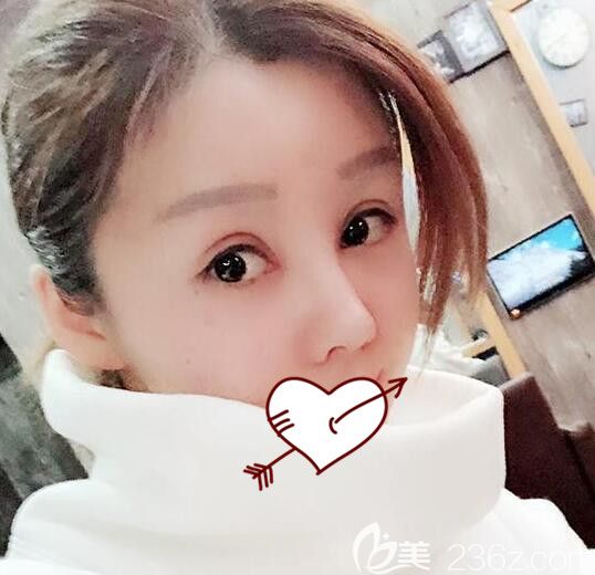 平行全切雙眼皮+開內(nèi)眼角眼綜合+鼻部修復(fù)術(shù)后第8天