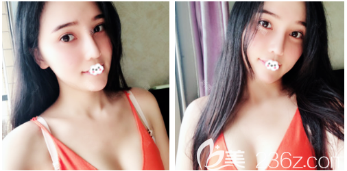 金孝憲做脂肪填充和鼻子怎么樣 金孝憲做脂肪填充和鼻子怎么樣