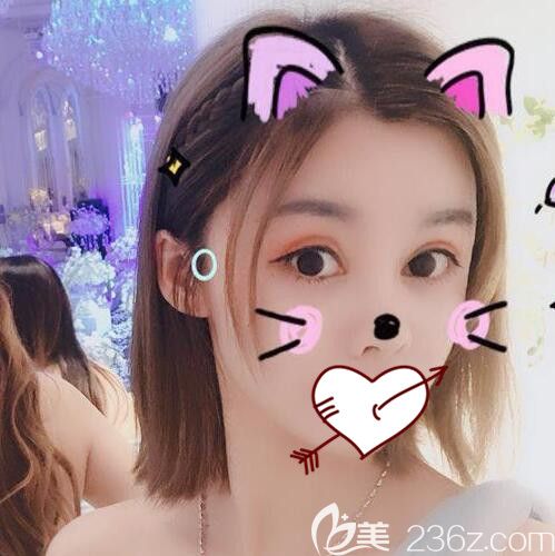 在合肥臺(tái)美麗格整形做全切平行雙眼皮+開(kāi)內(nèi)眼角眼綜合時(shí)，順便讓葉凡給我做了鼻部失敗修復(fù)