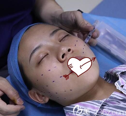 合肥臺美麗格葉凡給我做埋線提升術(shù)前設(shè)計(jì)