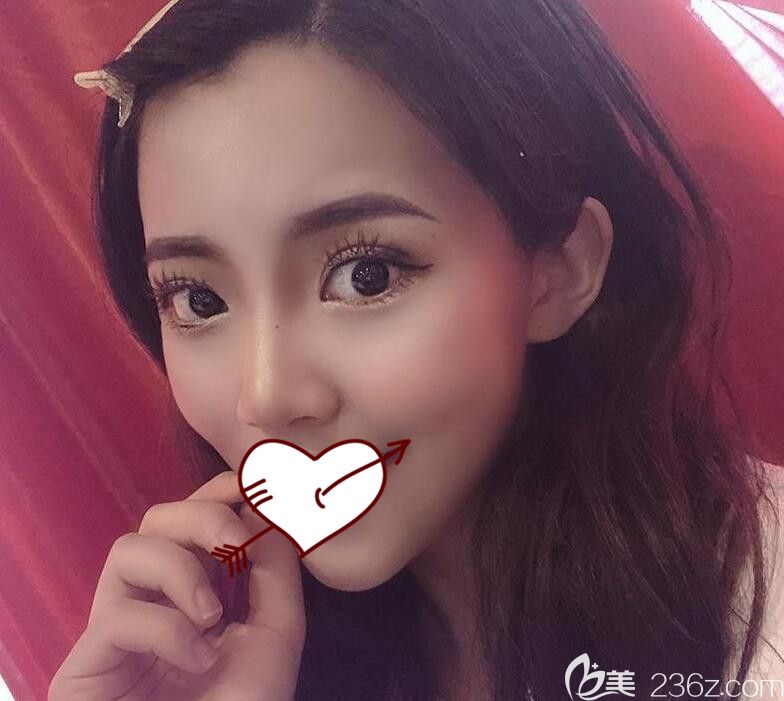 面部埋線提升術(shù)后10天恢復(fù)情況