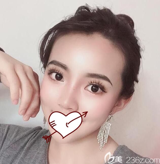 臺美麗格整形埋線提升第25天變化圖