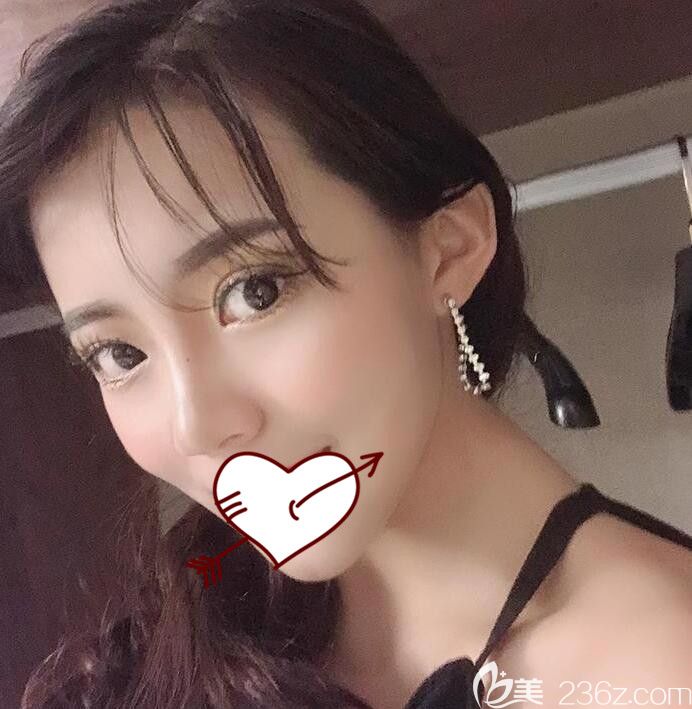 臉部提升埋線效果好不好？讓合肥臺(tái)美麗格整形葉凡給我做埋線面部提升僅僅40天效果就很明顯哦