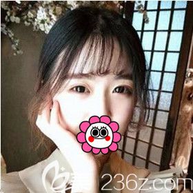 在大連做埋線雙眼皮半個月恢復效果