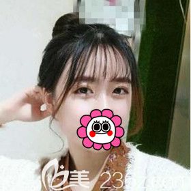 在大連沙醫(yī)生整形醫(yī)院做埋線雙眼皮術后20天恢復效果圖