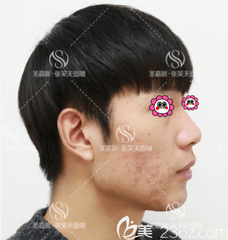 我在北京圣嘉新做下頜角長曲線截骨術(shù)前側(cè)面照