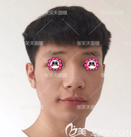 張笑天下頜角整形多少錢？北京圣嘉新下頜角整形價格和我第5個月效果參考