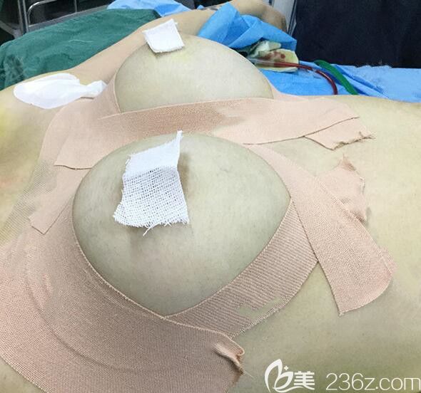 曼托假體隆胸+自體脂肪填充豐胸術(shù)后即刻照