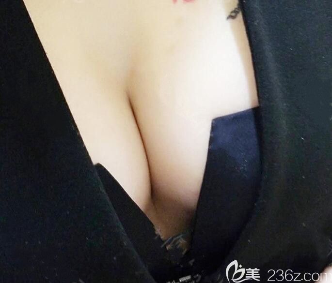 合肥臺美麗格整形隆胸術(shù)后第15天恢復(fù)圖